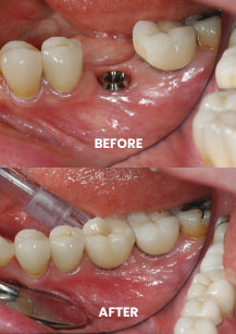 Before and After - Dental Implant