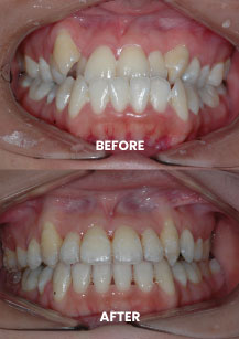 Before and After - Braces