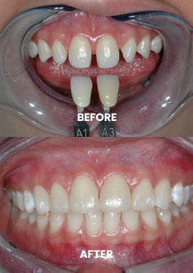 Before and After - Build Up With Composite