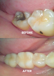 Before and After - Full Ceramic Crown On Crack Teeth