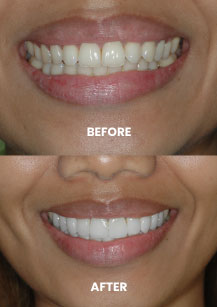 Before and After - Veneers