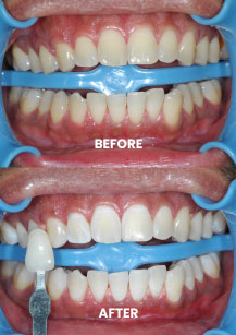 Before and After - Teeth Whitening